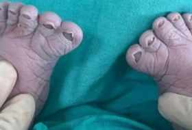 Мальчик с 12 пальцами родился в России